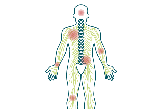 An illustration showing red pain dots scattered around the whole body