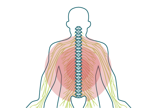 An illustration showing a red circle of pain radiating from the centre of the back