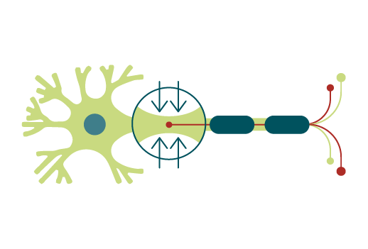 An illustration showing a compressed nerve